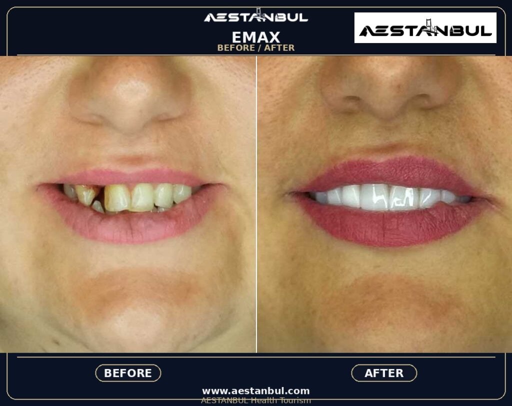 Dental Veneers Europe Package - Dental Veneers Europe Package: Package Review for European Patients for 2026