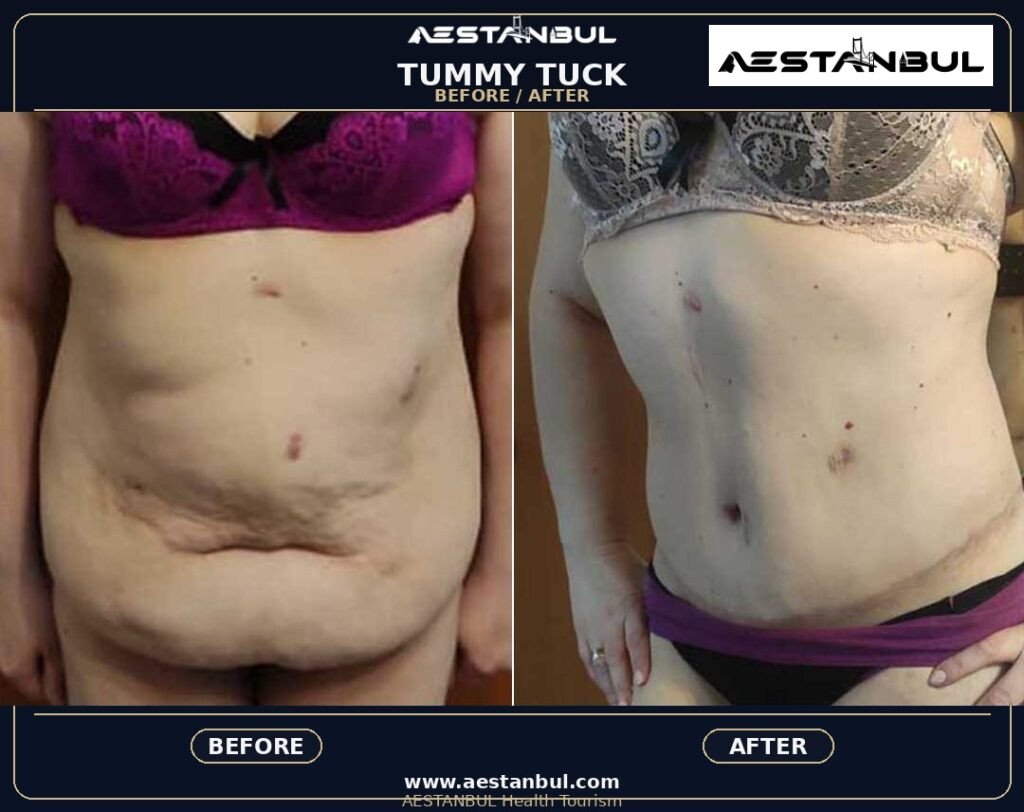 Tummy Tuck Deposit Questions - Tummy Tuck Deposit Questions: Deposit Questions Before Booking for 2026