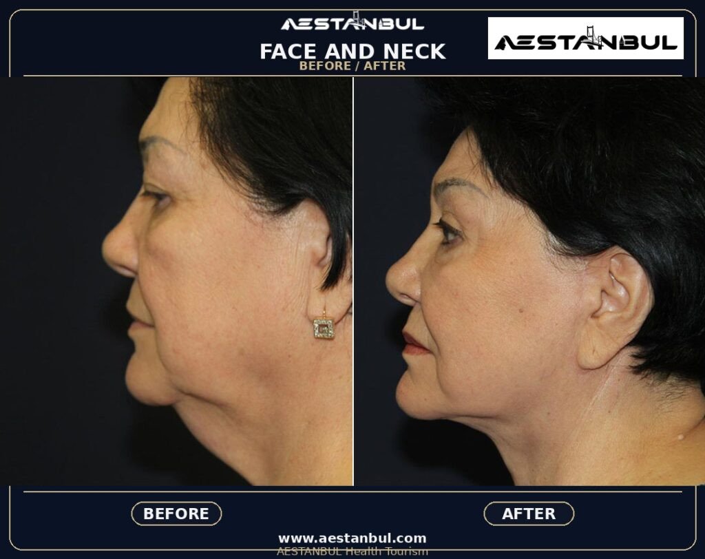 Facelift UK Checklist - Facelift Uk Checklist: UK Patient Checklist for 2026