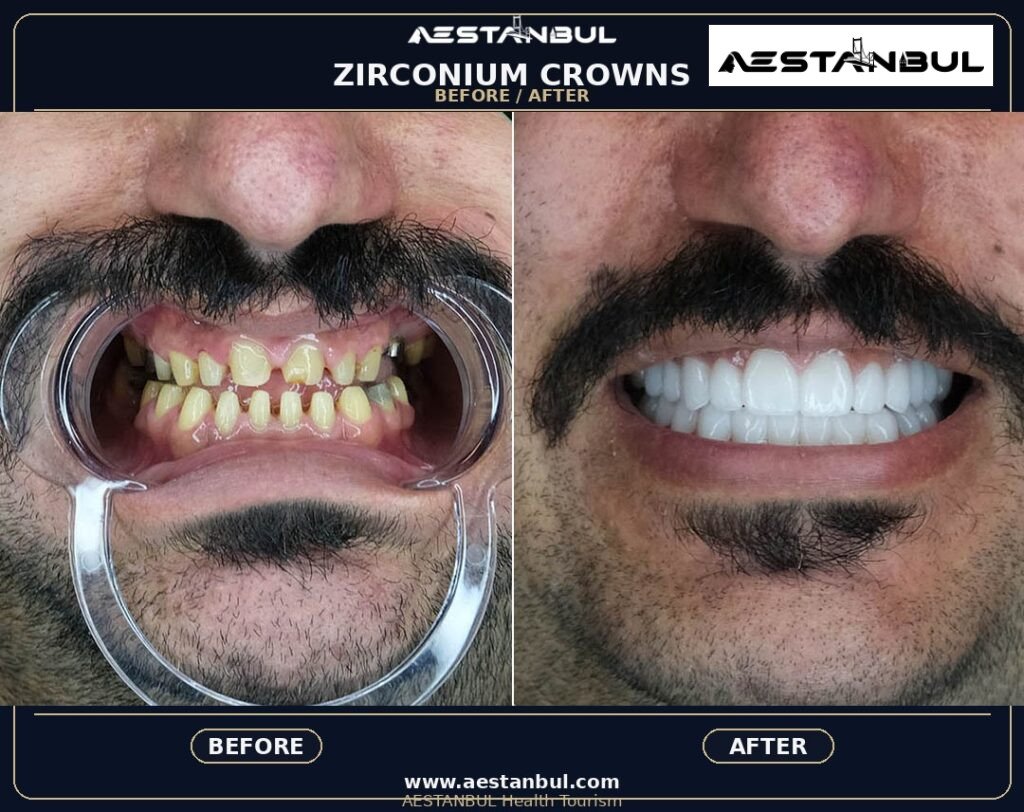 Dental Crowns Price Safety - Dental Crowns Price Safety: Price Versus Safety Comparison for 2026