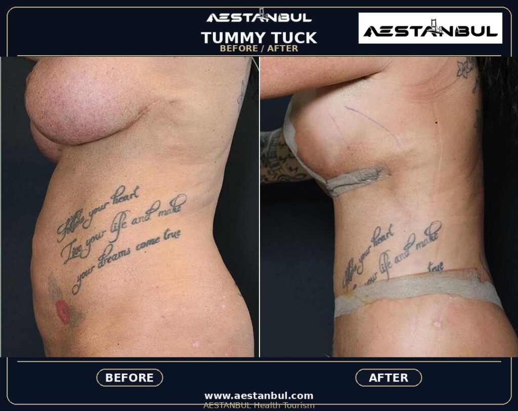 tummy tuck before and after Turkey - Tummy Tuck Before And After Turkey: Results, Safety and Patient Questions