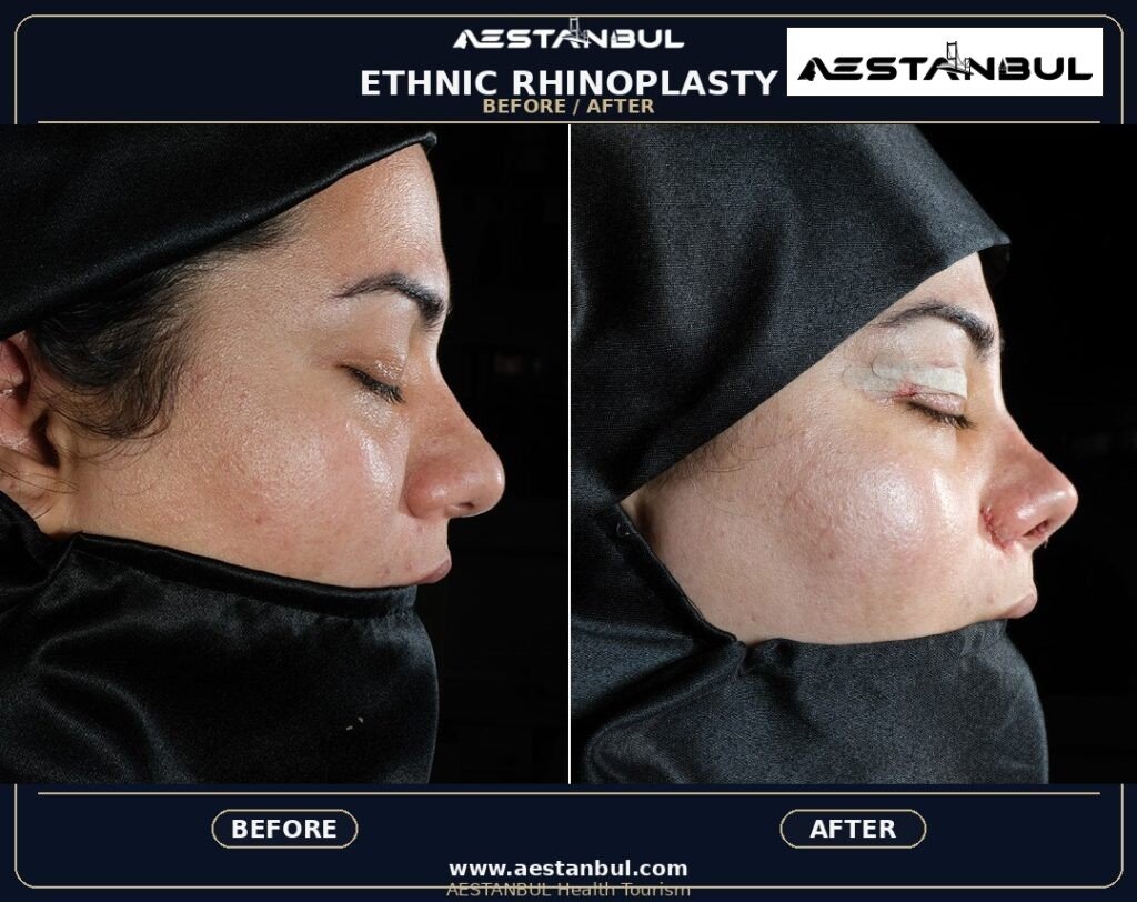 ethnic rhinoplasty Turkey - Ethnic Rhinoplasty Turkey: Patient Guide in Turkey