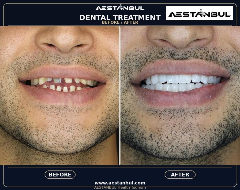 dental tourism Turkey - Dental Tourism Turkey: Patient Guide in Turkey