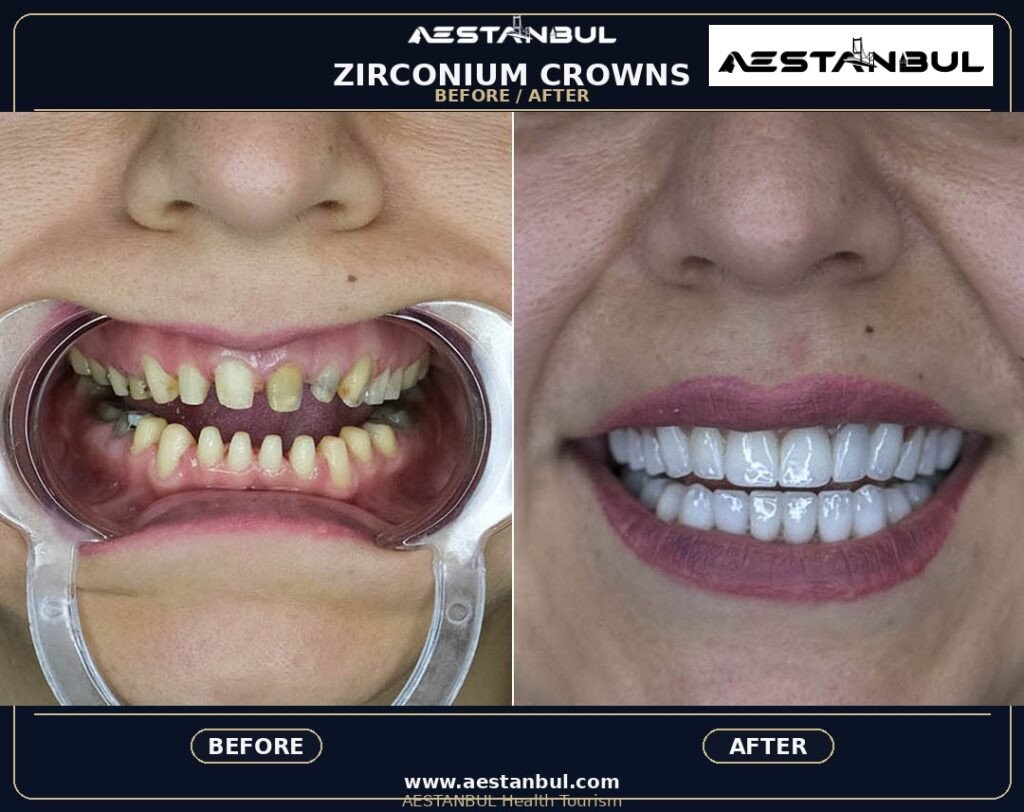 Metal Supported Porcelain - Metal Supported Porcelain: Patient Guide in Turkey