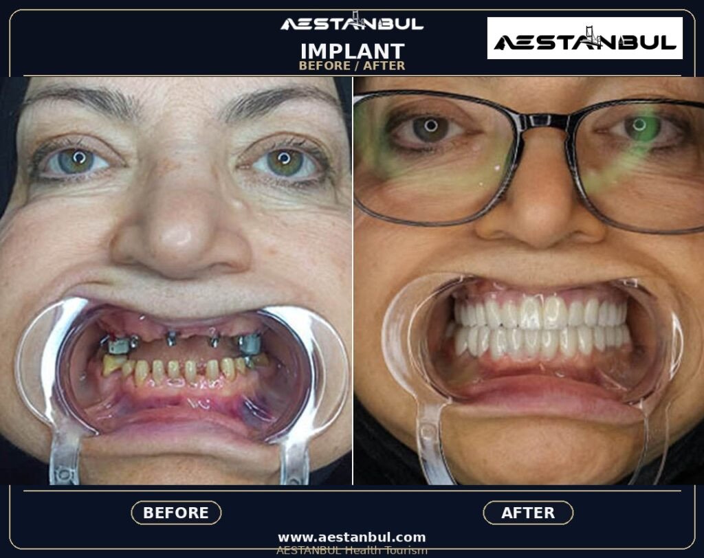 Dental Implants Photo Consultation - Dental Implants Photo Consultation: Photo Consultation Checklist for 2026