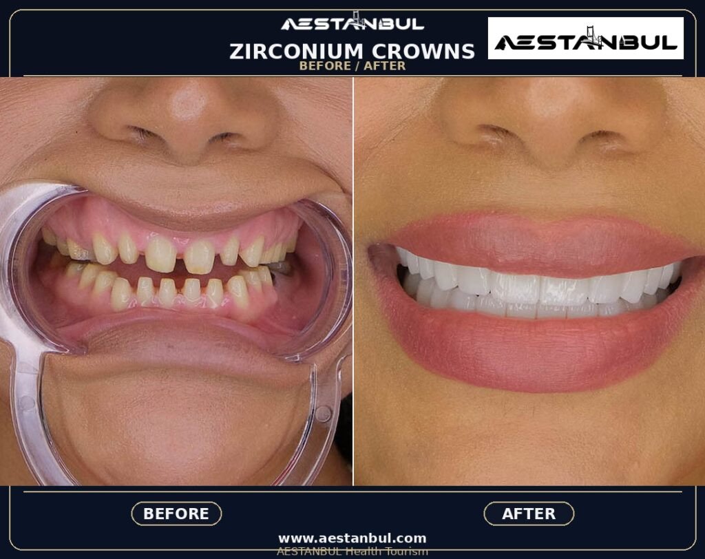 Metal Supported Porcelain - Metal Supported Porcelain: Patient Guide in Turkey