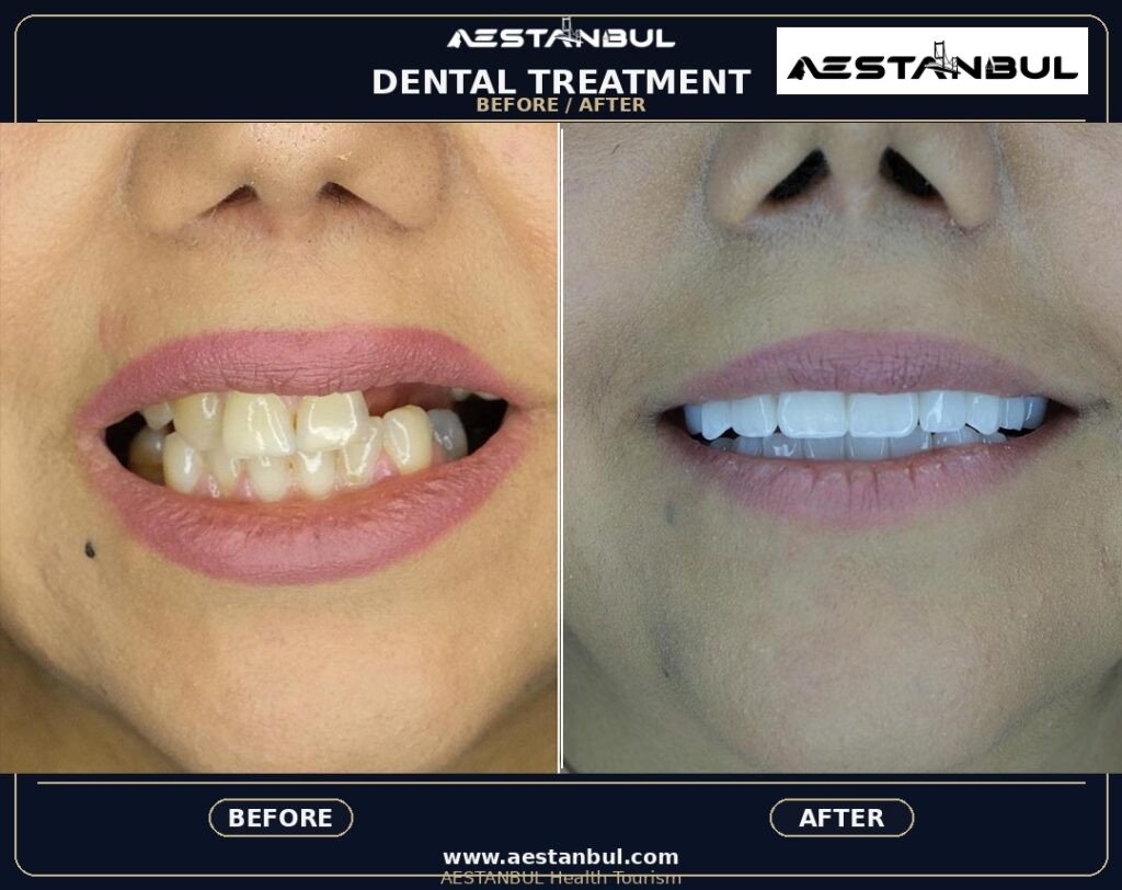 dental tourism Turkey - Dental Tourism Turkey: Patient Guide in Turkey