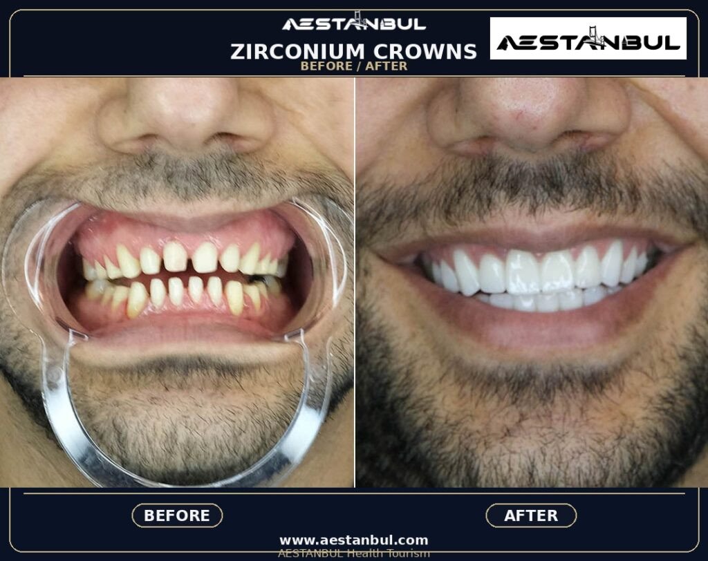 Dental Crowns Travel Guide: First-Time Medical Travel Guide for 2026 14 25af13b8