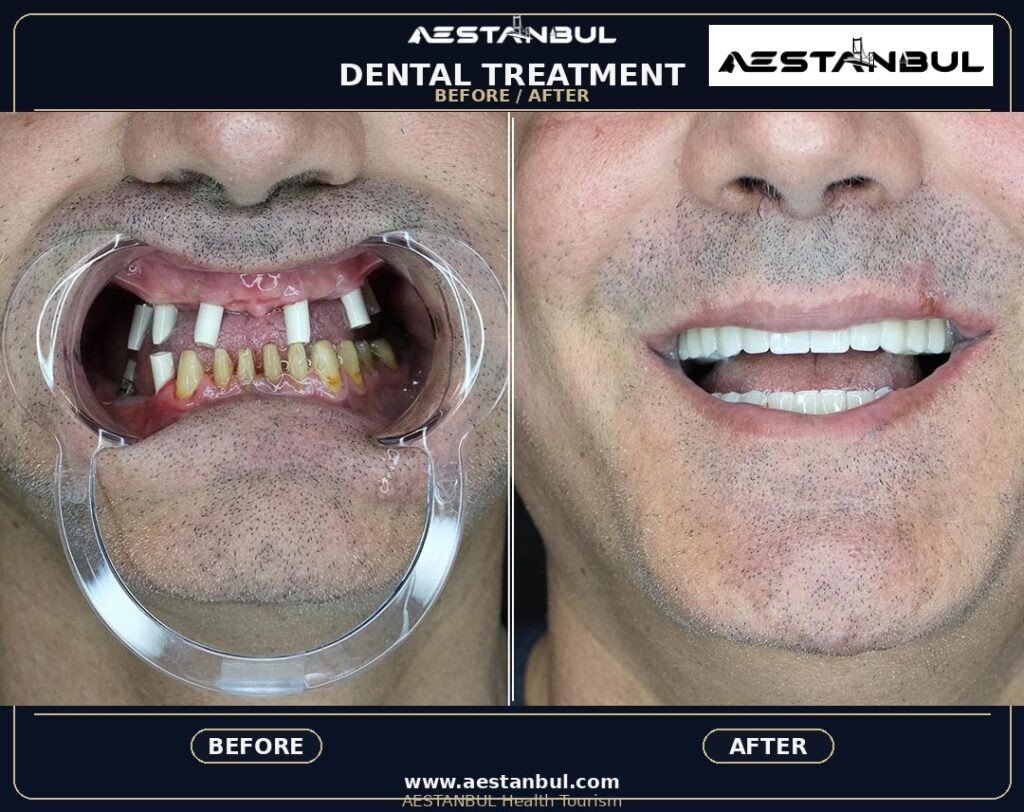 dental tourism Turkey - Dental Tourism Turkey: Patient Guide in Turkey