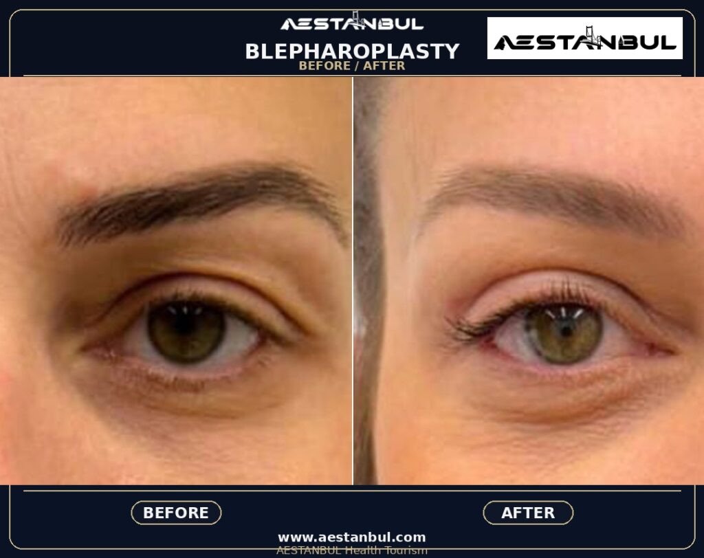Blepharoplasty Revision Questions - Blepharoplasty Revision Questions: Revision Risk Questions for 2026