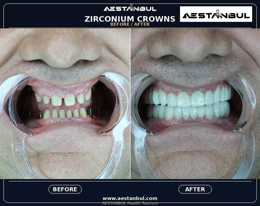 Dental Crowns Price Safety - Dental Crowns Price Safety: Price Versus Safety Comparison for 2026