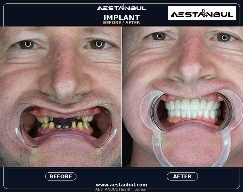 All-on-4 Dental Implants Deposit Questions - All-on-4 Dental Implants Deposit Questions: Deposit Questions Before Booking for 2026