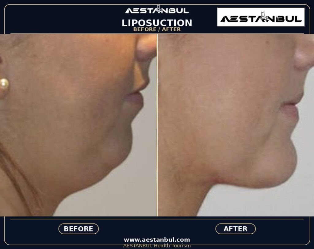 Lip Filler Europe Package - Lip Filler Europe Package: Package Review for European Patients for 2026