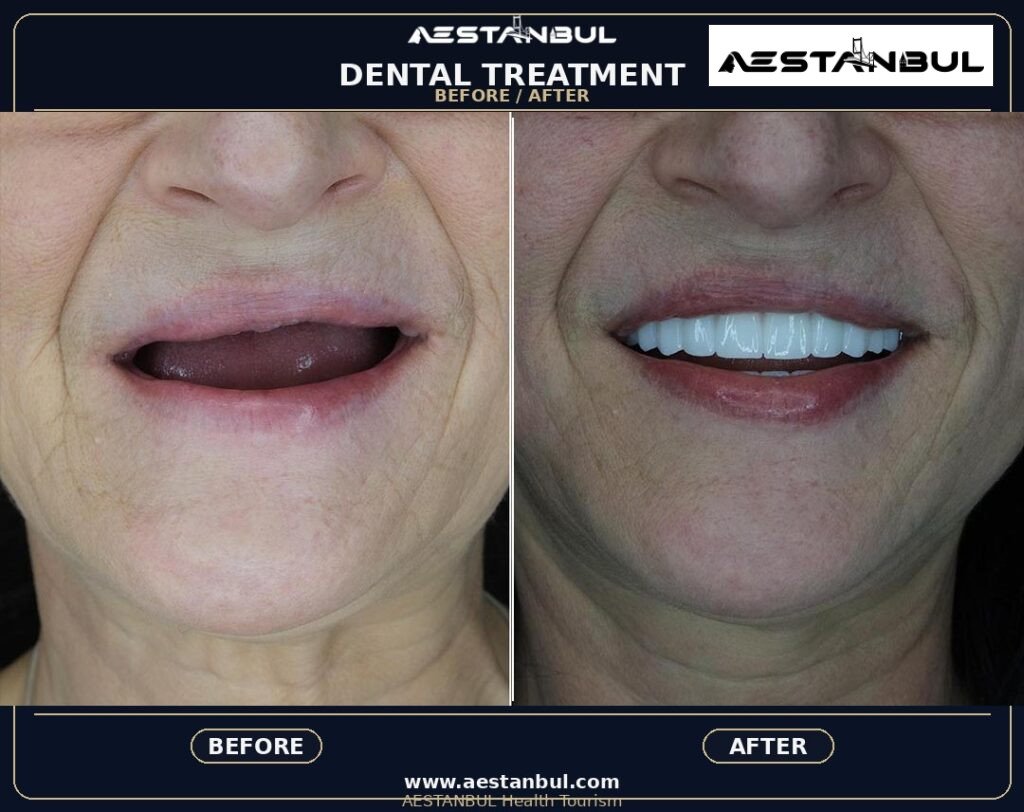 Hollywood Smile Aftercare Timeline - Hollywood Smile Aftercare Timeline: Aftercare Timeline Questions for 2026