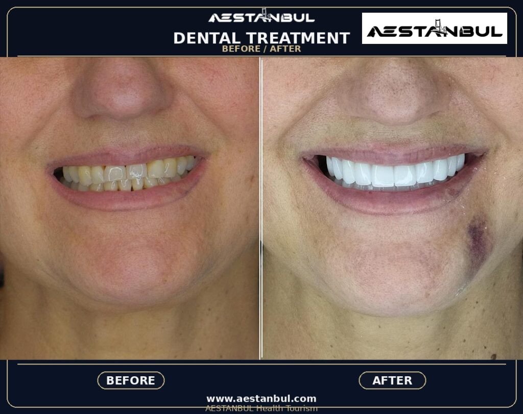 Hollywood Smile Aftercare Timeline - Hollywood Smile Aftercare Timeline: Aftercare Timeline Questions for 2026