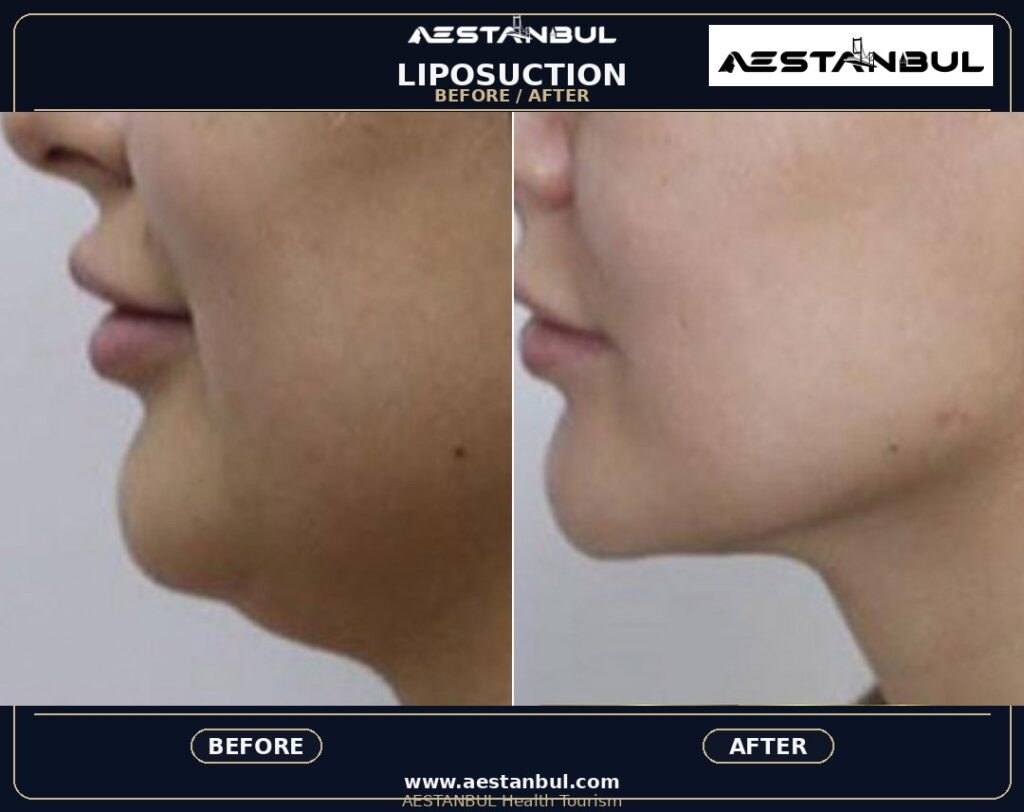 Lip Filler Europe Package - Lip Filler Europe Package: Package Review for European Patients for 2026