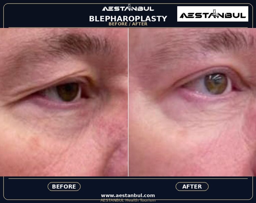 Blepharoplasty Revision Questions - Blepharoplasty Revision Questions: Revision Risk Questions for 2026