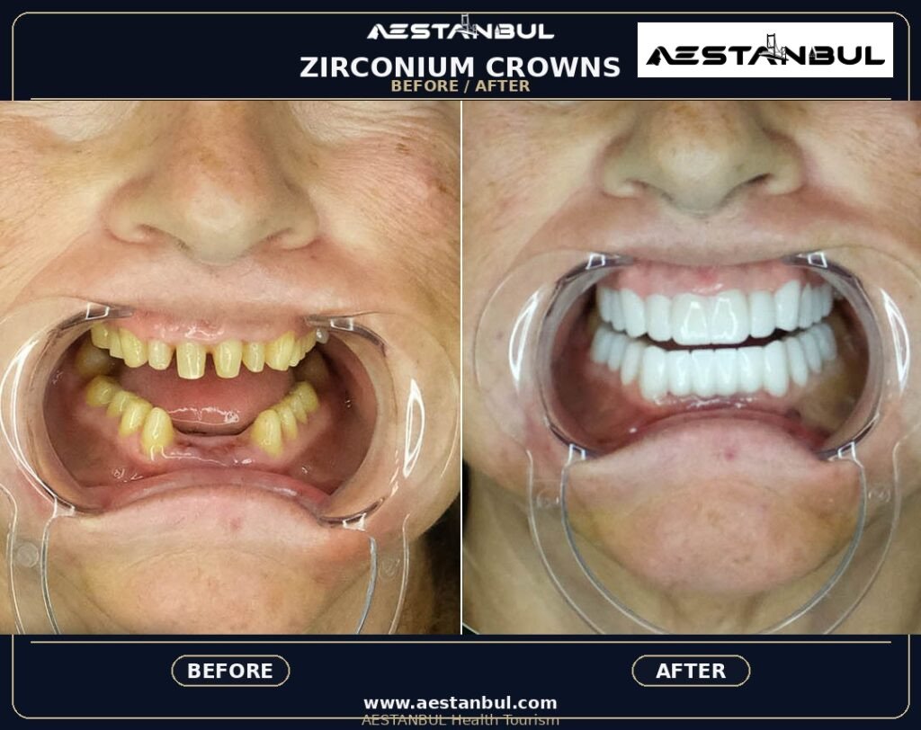Dental Crowns Price Safety - Dental Crowns Price Safety: Price Versus Safety Comparison for 2026