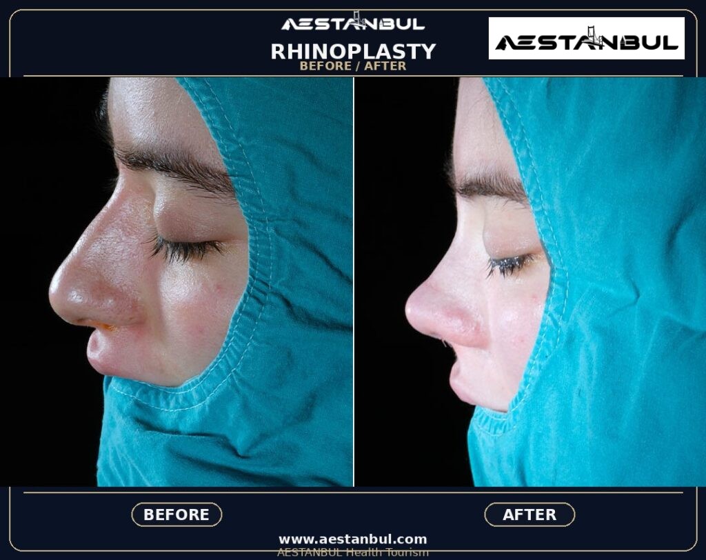 rhinoplasty before and after Turkey - Rhinoplasty Before And After Turkey: Results, Safety and Patient Questions