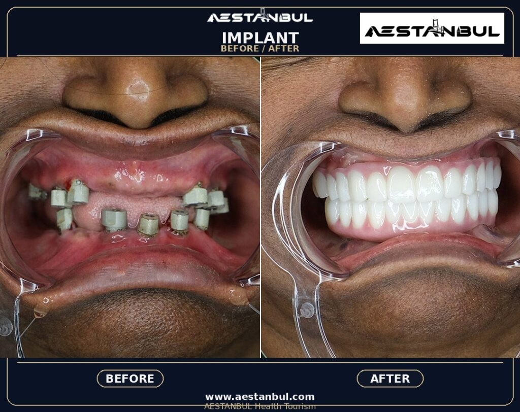 All-on-4 Dental Implants Hotel Transfer: Hotel and Transfer Planning Guide for 2026 17 2ee60325