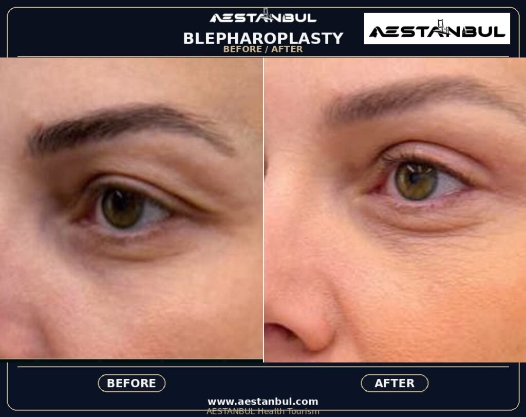 Blepharoplasty Price Safety - Blepharoplasty Price Safety: Price Versus Safety Comparison for 2026