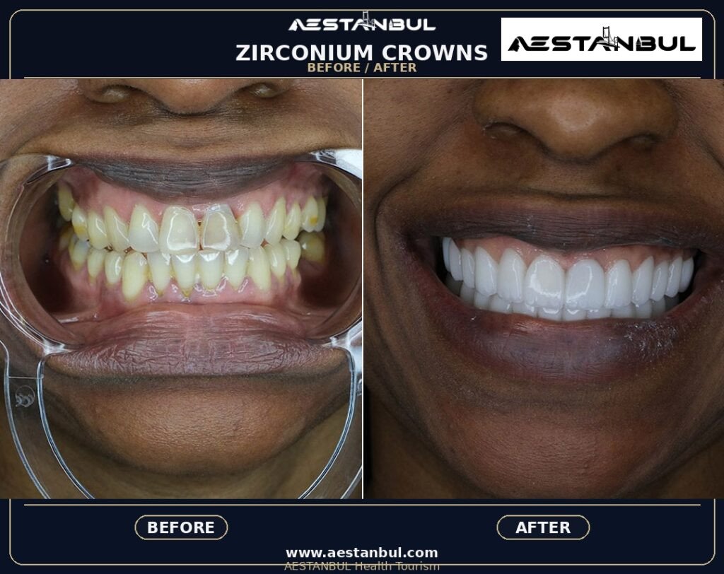Dental Crowns Travel Guide - Dental Crowns Travel Guide: First-Time Medical Travel Guide for 2026