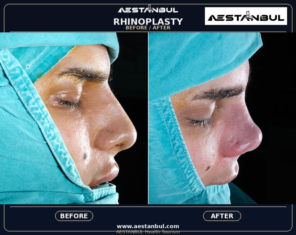 rhinoplasty before and after Turkey - Rhinoplasty Before And After Turkey: Results, Safety and Patient Questions