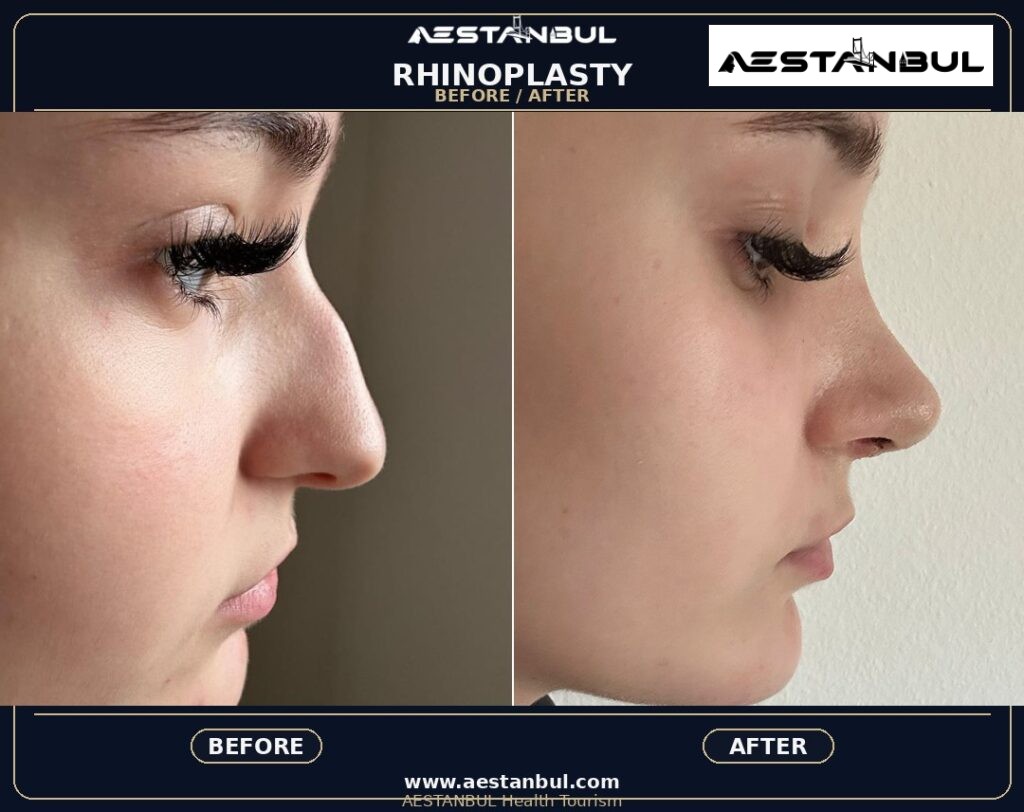 rhinoplasty before and after Turkey - Rhinoplasty Before And After Turkey: Results, Safety and Patient Questions