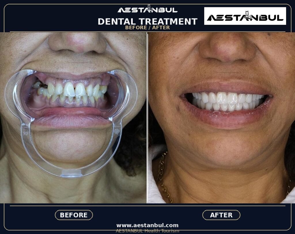 Smile Makeover: Patient Guide in Turkey 19 28ba0c30