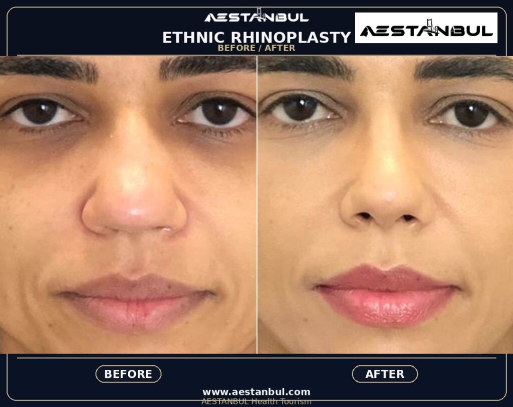 ethnic rhinoplasty Turkey - Ethnic Rhinoplasty Turkey: Patient Guide in Turkey