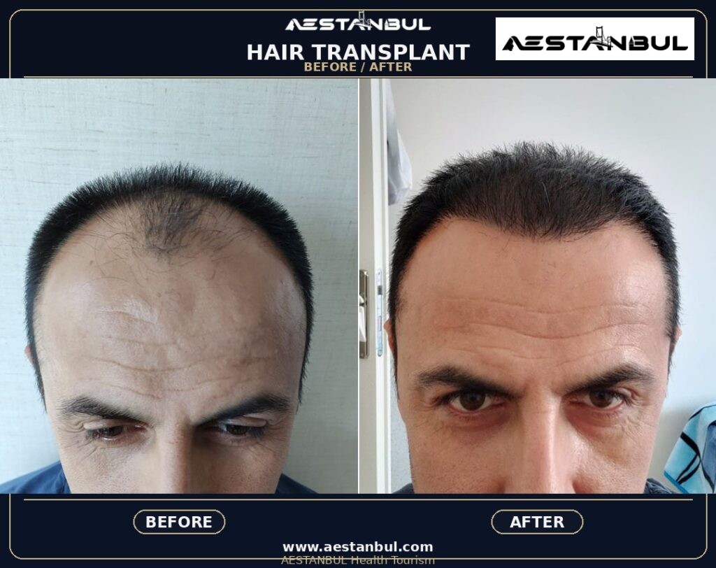 laser hair removal Istanbul - Laser Hair Removal Istanbul: What International Patients Should Know