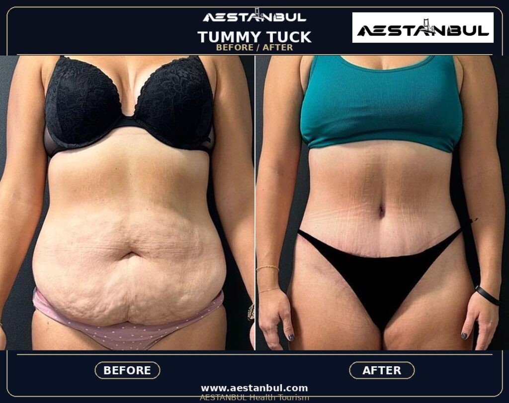 tummy tuck before and after Turkey - Tummy Tuck Before And After Turkey: Results, Safety and Patient Questions