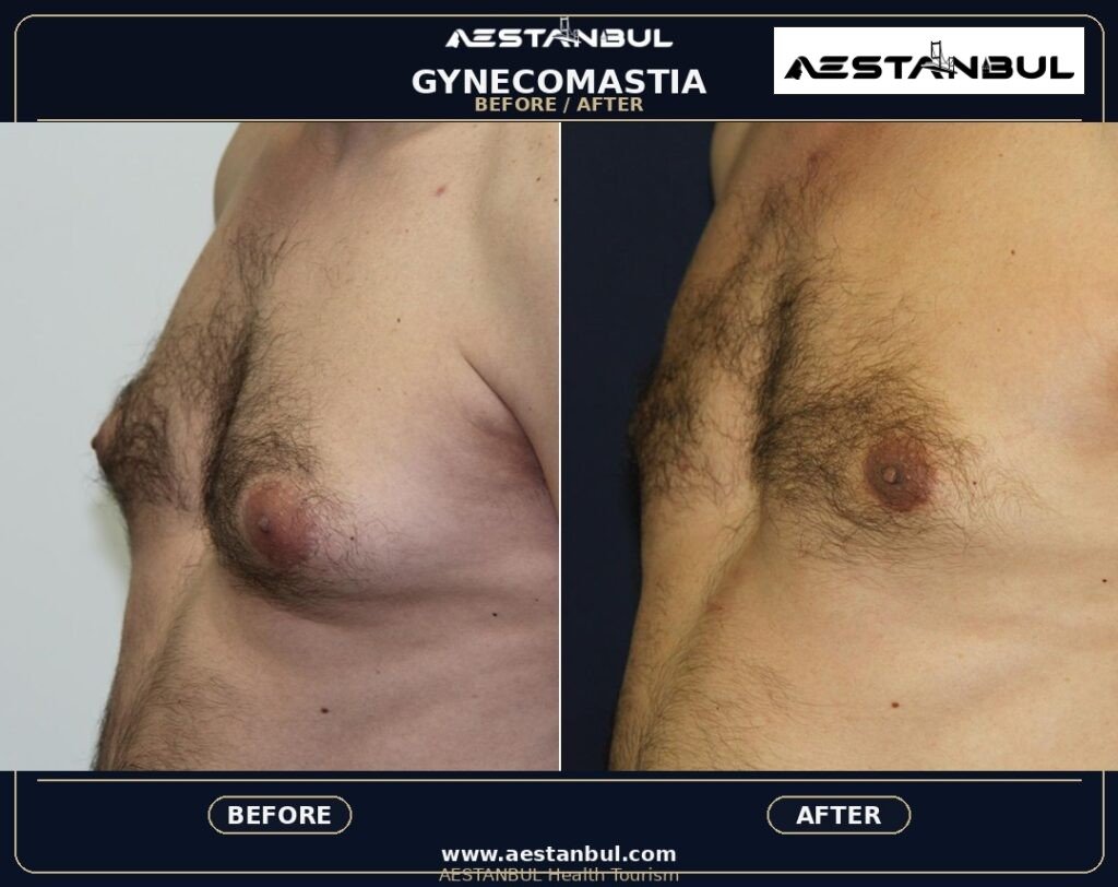 gynecomastia Turkey - Gynecomastia Turkey: Patient Guide in Turkey