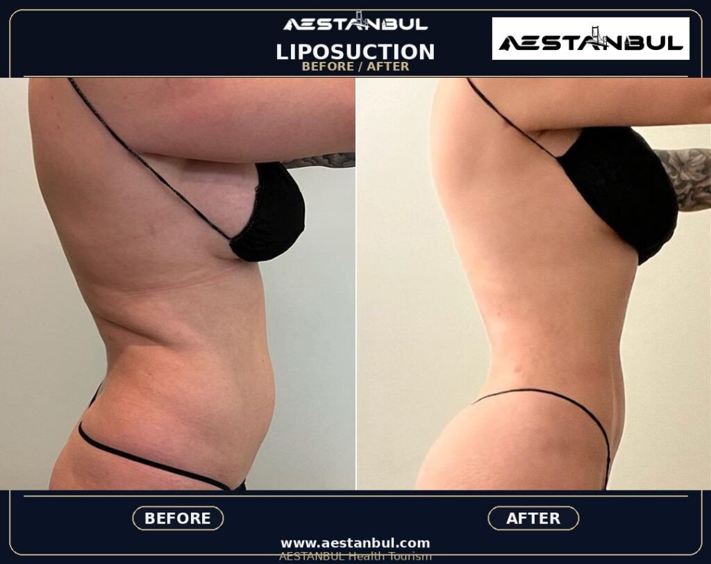 Liposuction Travel Guide - Liposuction Travel Guide: First-Time Medical Travel Guide for 2026