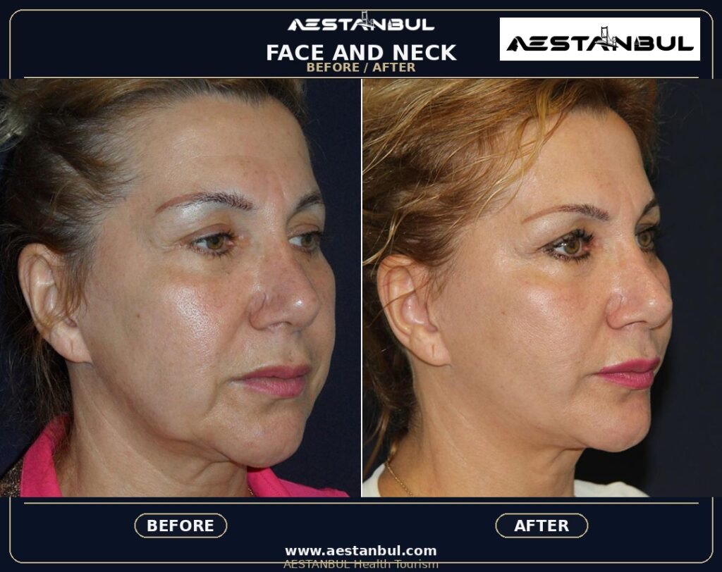 Facelift UK Checklist - Facelift Uk Checklist: UK Patient Checklist for 2026