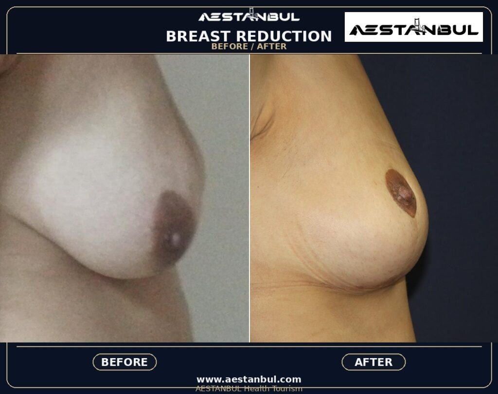 breast reduction Turkey - Breast Reduction Turkey: Patient Guide in Turkey