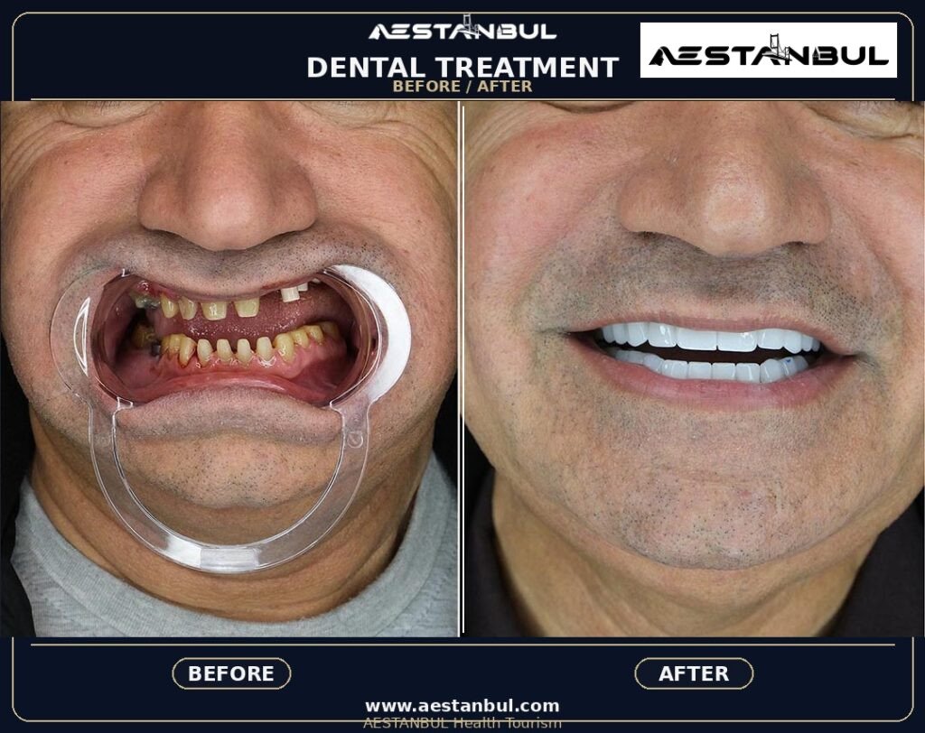 dental tourism Turkey - Dental Tourism Turkey: Patient Guide in Turkey