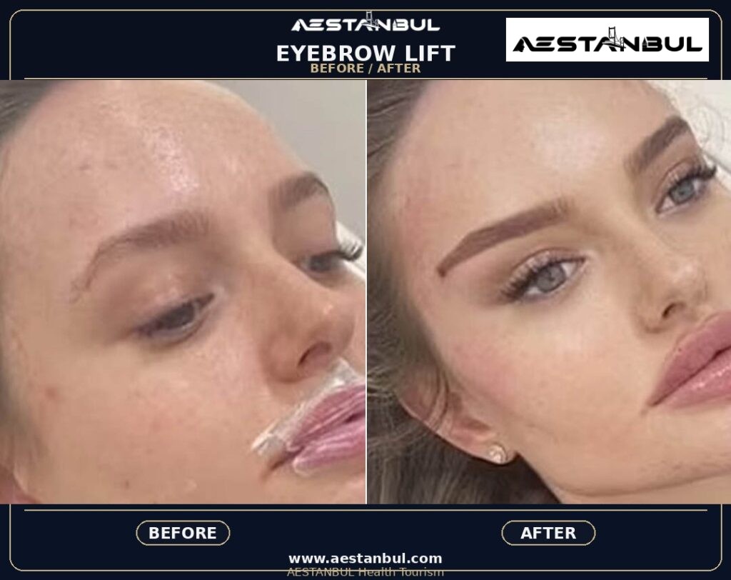 eyebrow transplant Istanbul - Eyebrow Transplant Istanbul: What International Patients Should Know