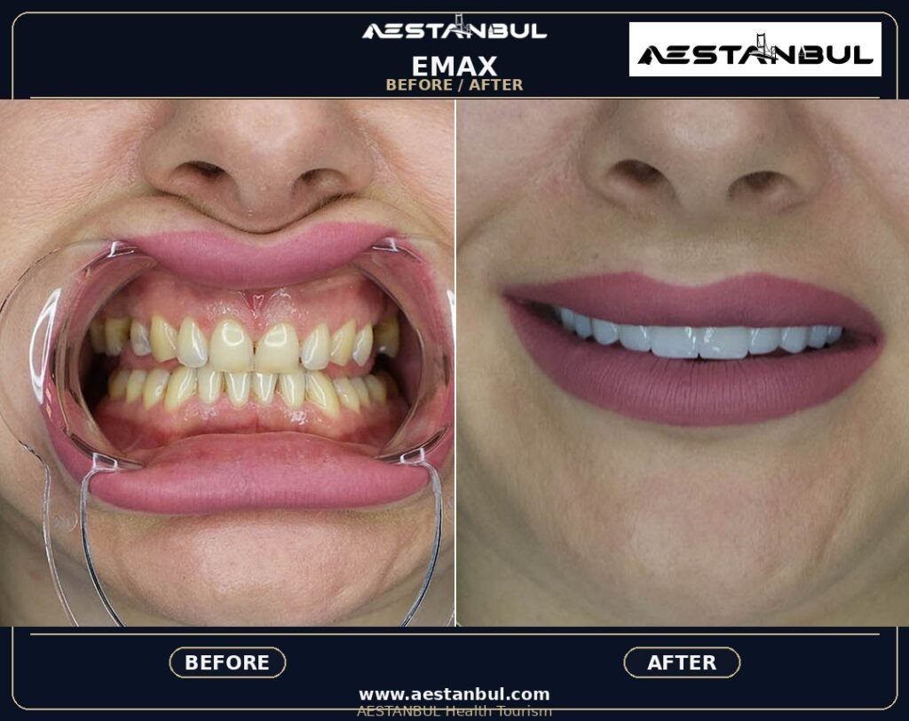 Dental Veneers Europe Package - Dental Veneers Europe Package: Package Review for European Patients for 2026