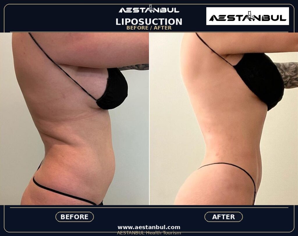 liposuction before and after Turkey - Liposuction Before And After Turkey: Results, Safety and Patient Questions
