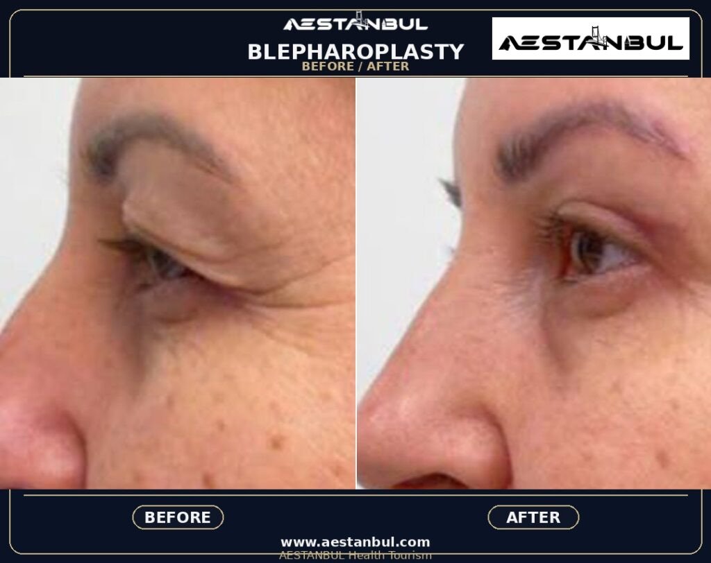 Blepharoplasty Price Safety - Blepharoplasty Price Safety: Price Versus Safety Comparison for 2026
