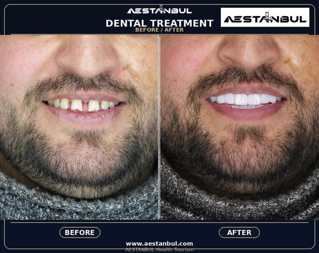 Smile Makeover - Smile Makeover: Patient Guide in Turkey