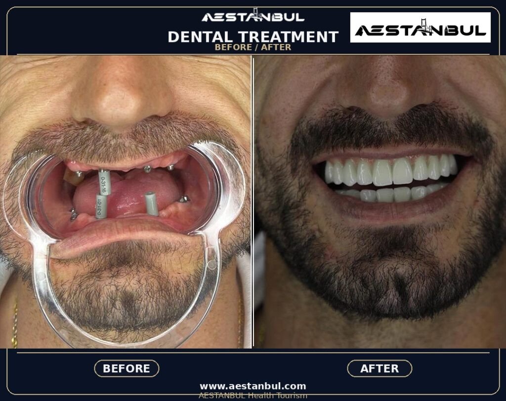 Hollywood Smile Aftercare Timeline - Hollywood Smile Aftercare Timeline: Aftercare Timeline Questions for 2026