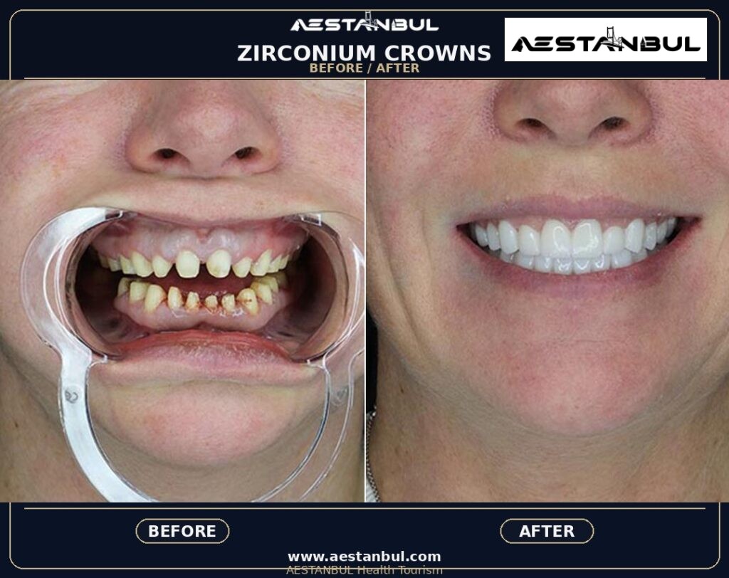 Dental Crowns Aftercare Timeline - Dental Crowns Aftercare Timeline: Aftercare Timeline Questions for 2026