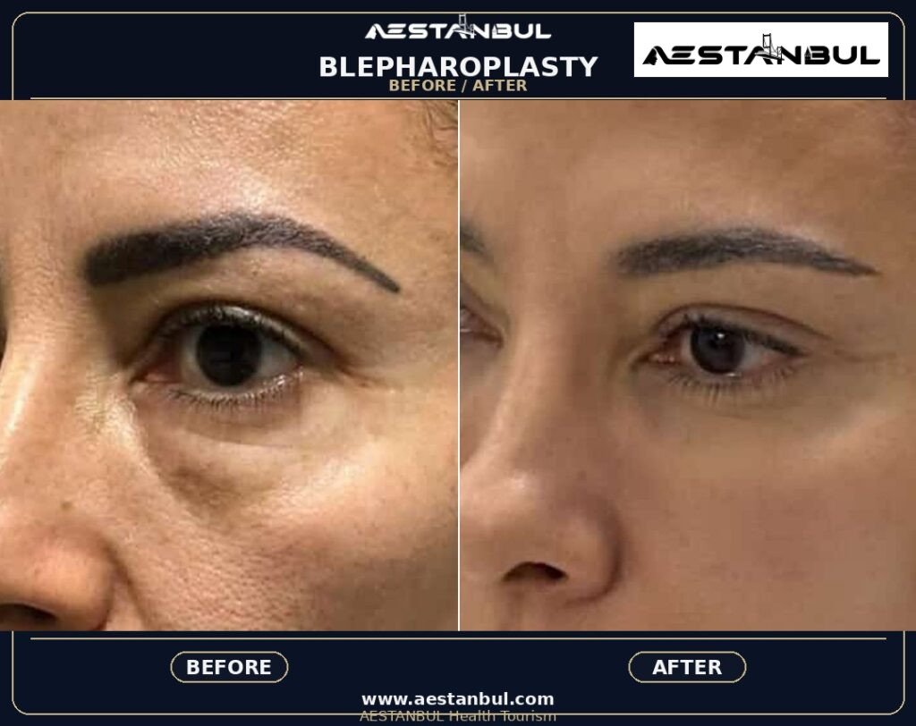 Blepharoplasty Revision Questions - Blepharoplasty Revision Questions: Revision Risk Questions for 2026