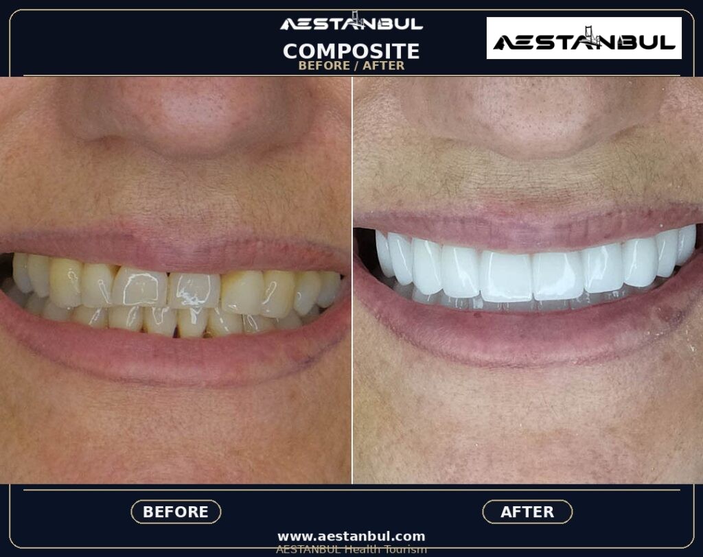 composite bonding Turkey - Composite Bonding Turkey: What International Patients Should Know