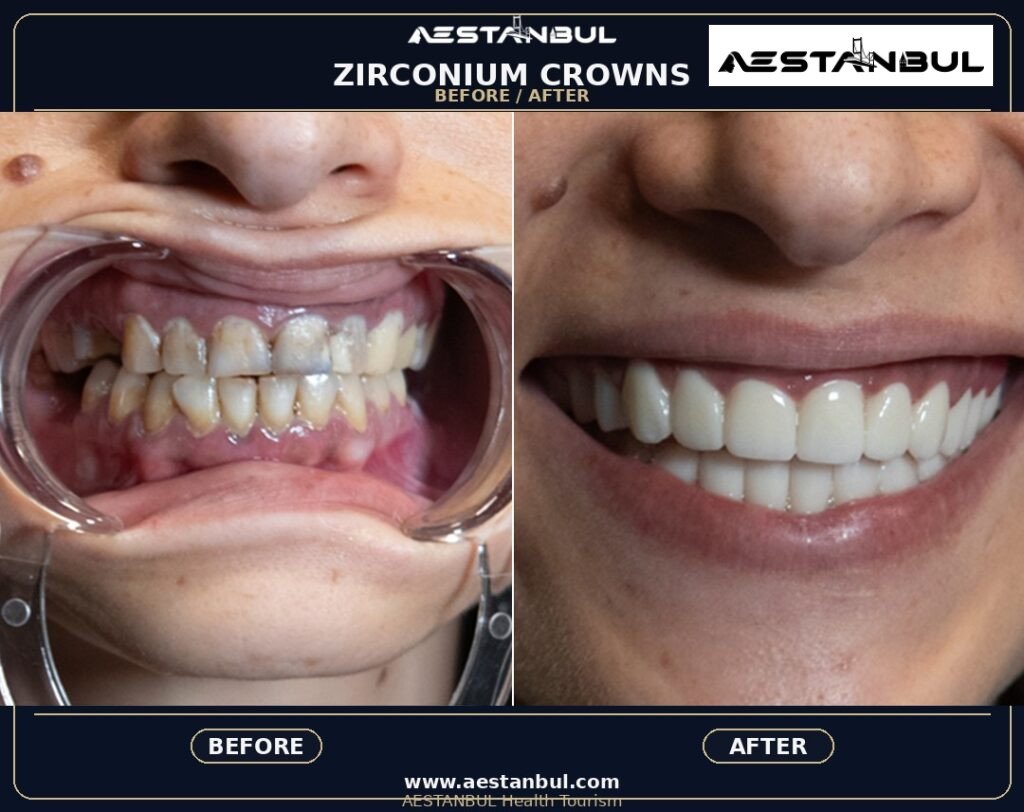 Metal Supported Porcelain - Metal Supported Porcelain: Patient Guide in Turkey