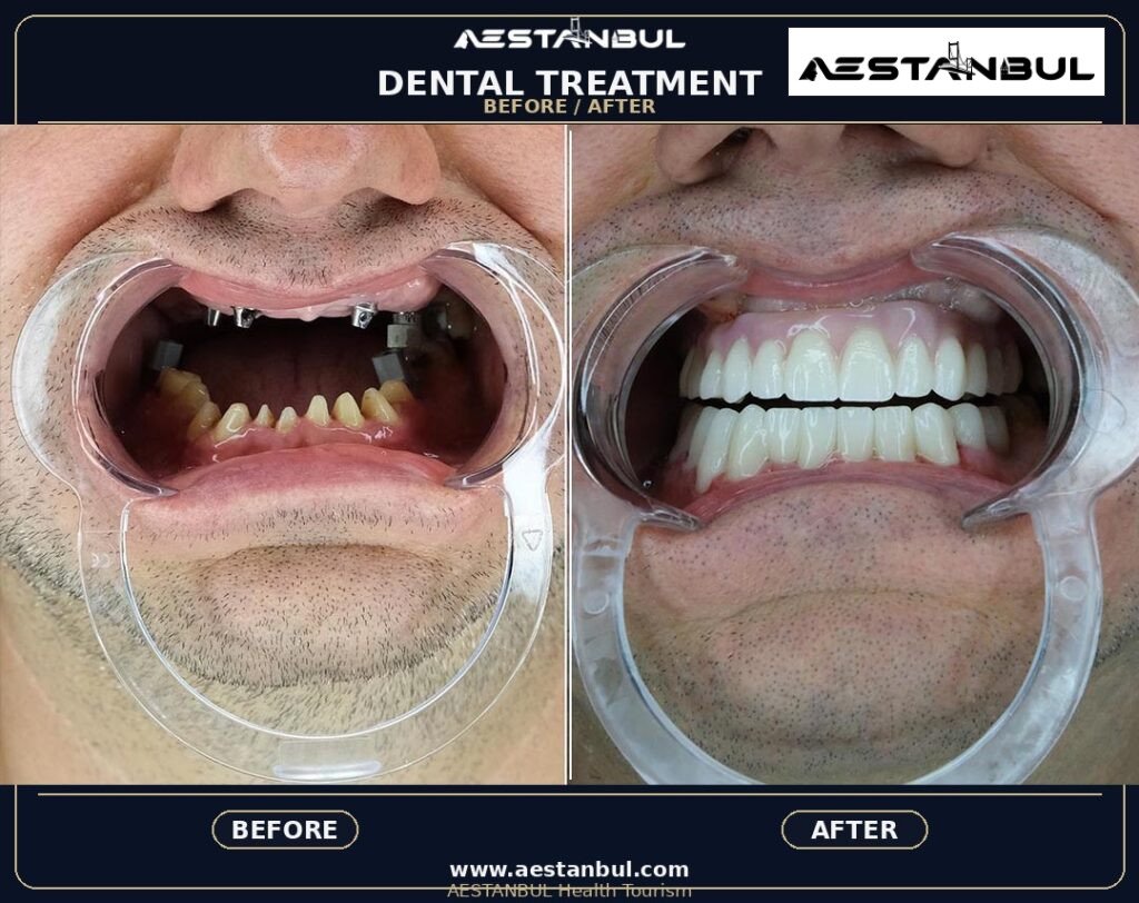 Dental Treatment Prices In Turkey: Cost, Safety and Clinic Planning 24 E0001913