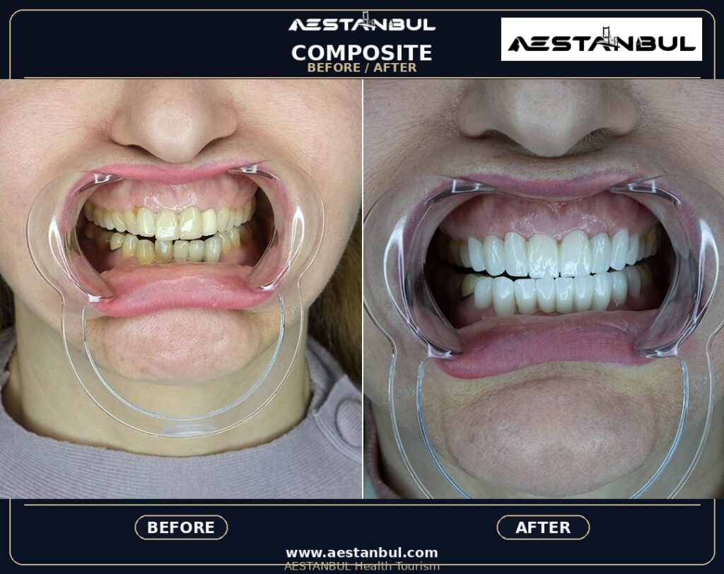 composite bonding Turkey - Composite Bonding Turkey: What International Patients Should Know