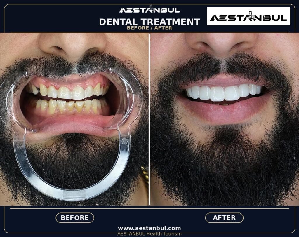 Smile Makeover - Smile Makeover: Patient Guide in Turkey